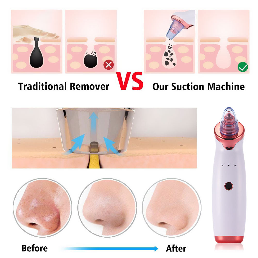 Electric Acne & Blackhead Remover